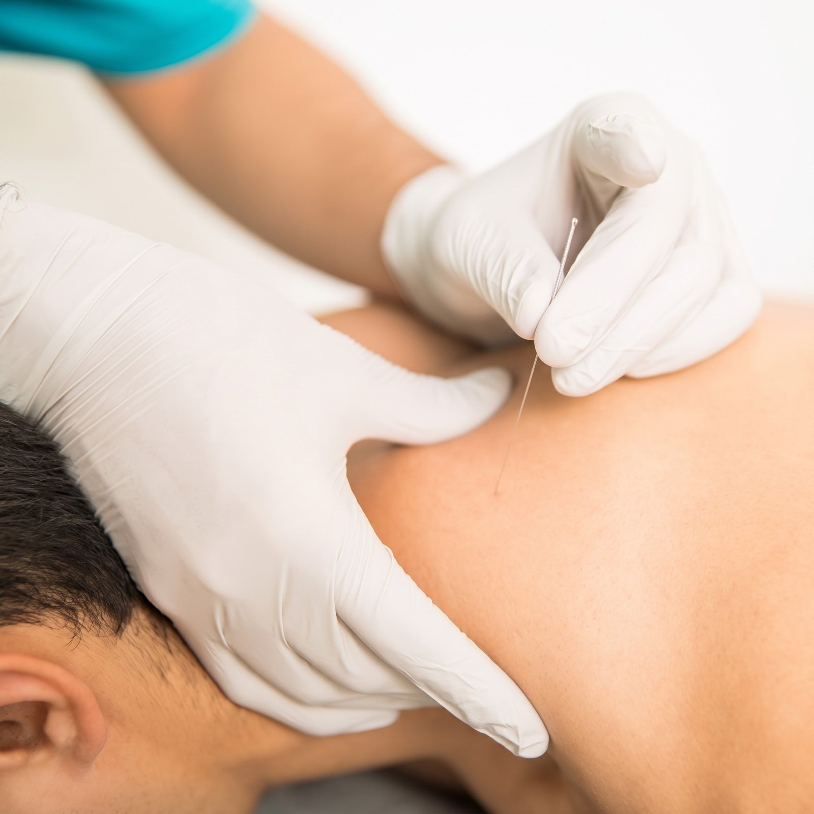 Dry Needling